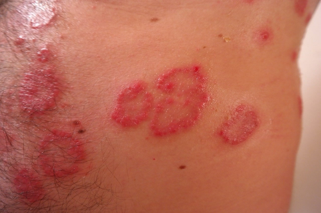 psoriazis vij kakvo go prichinqva kakwi sa simptomite i kak da se lekuvame
